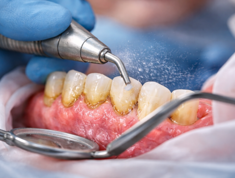 Miért fontos a fogkő eltávolítása?