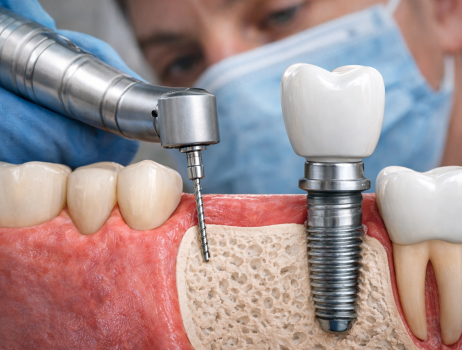 Mikor érdemes fogászati implantátumot beültetni